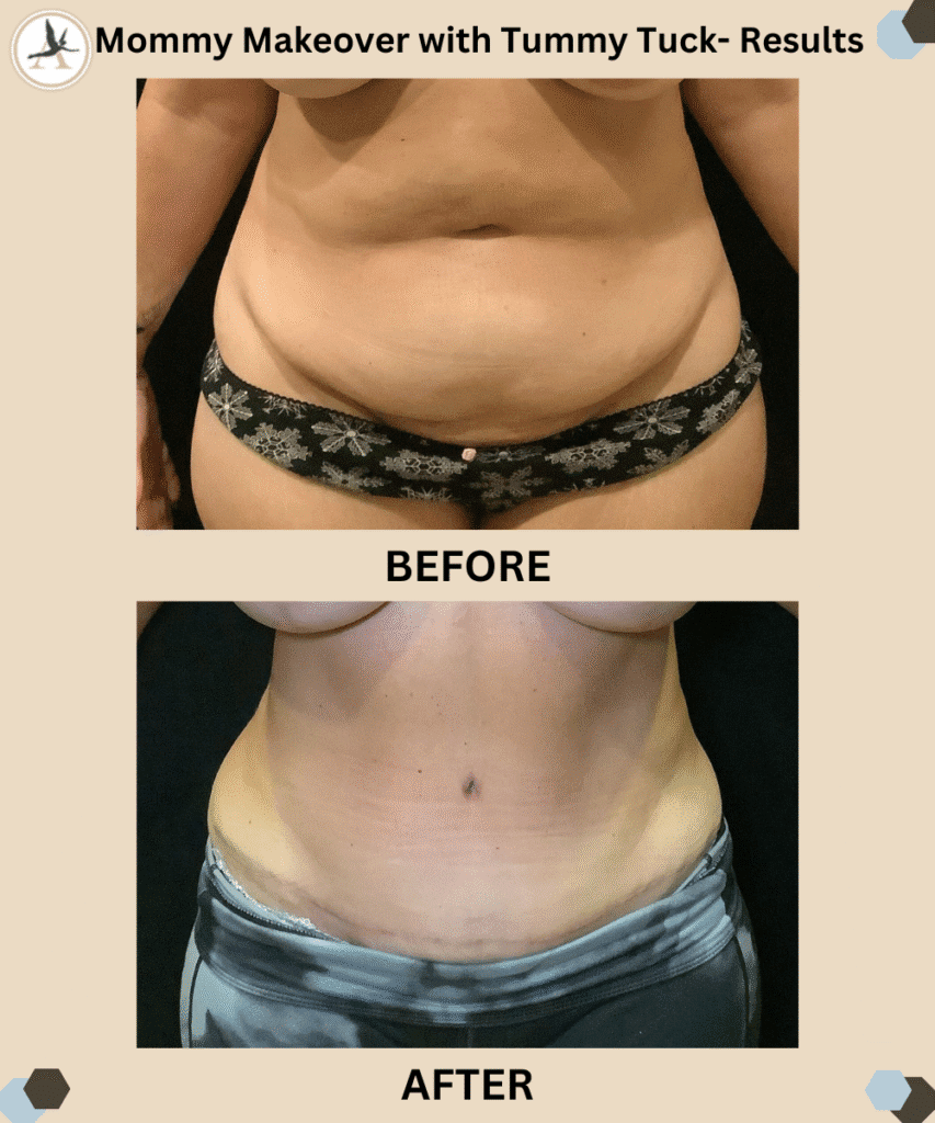 Slim Your Stomach as Part of Your Mommy Makeover in Tampa, FL_Mommy Makeover with Tummy Tuck- Results