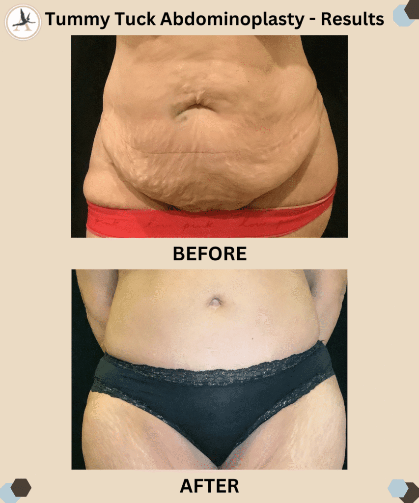 Tummy Tuck Abdominoplasty - Results_4 Unique Benefits Tummy Tuck - Beyond Aesthetic Improvement