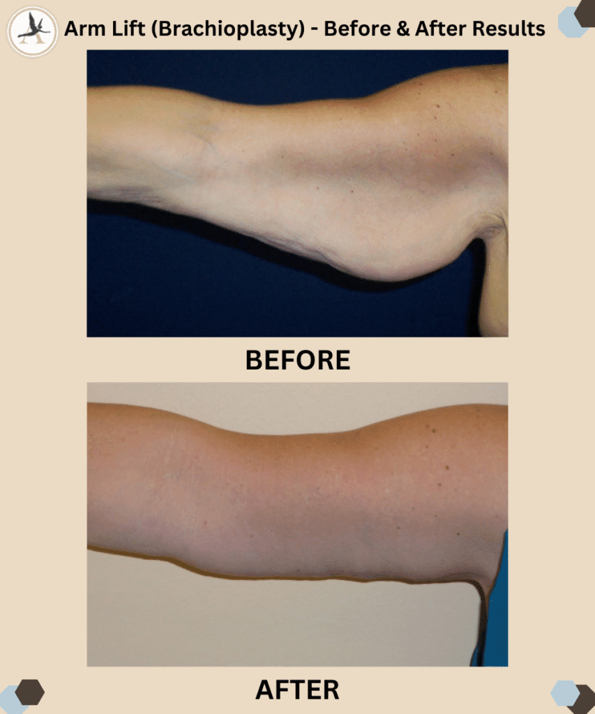 Arm Lift (Brachioplasty) Surgery Before and After Results in Tampa Bay, Florida