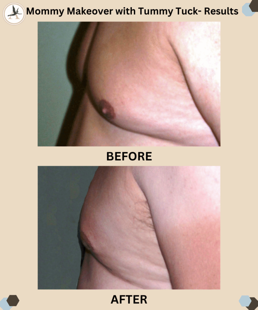 Male Breast Reduction Misconceptions - Achieve Masculine Chest_Before After Results Tampa, Bay, Florida