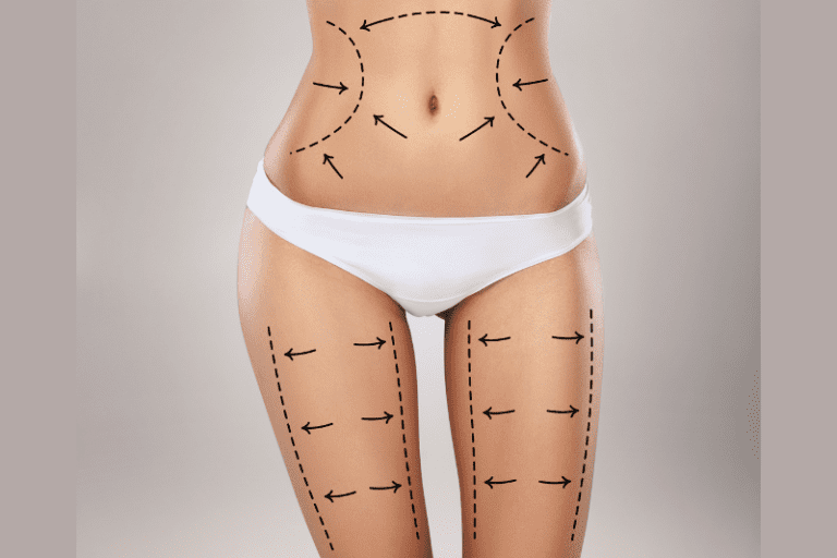 Different Types of Liposuction - Targeted Fat Reduction Tampa, Florida