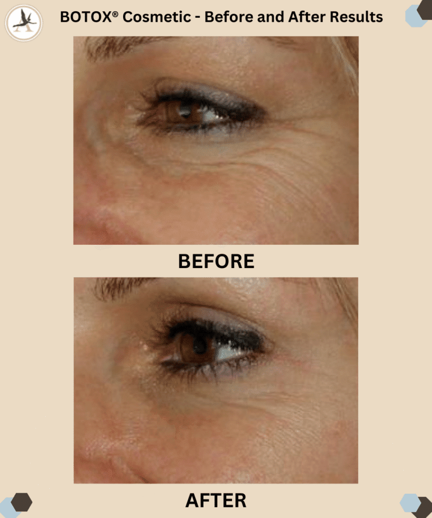 Before and After Results_ BOTOX® Cosmetic Around Your Eyes Tampa Bay, Florida