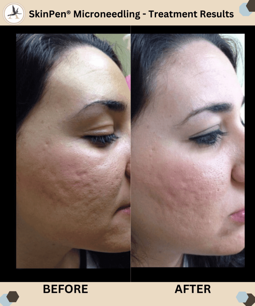 SkinPen® Microneedling - Treatment Before and After Results Tampa Bay, Florida
