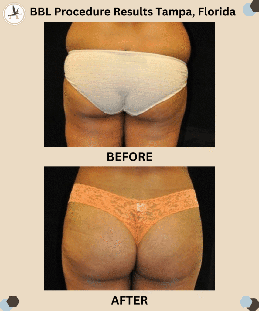 BBL Procedure Before and After Results Tampa, Florida_Brazilian vs Buttock Implants - Advantages, Drawbacks