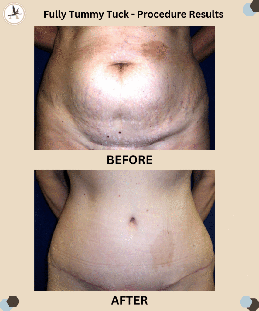 Fully Tummy Tuck - Procedure Before and After Results in Tampa, Florida_Tummy Tuck Recovery Rules and Tips For Ideal Results