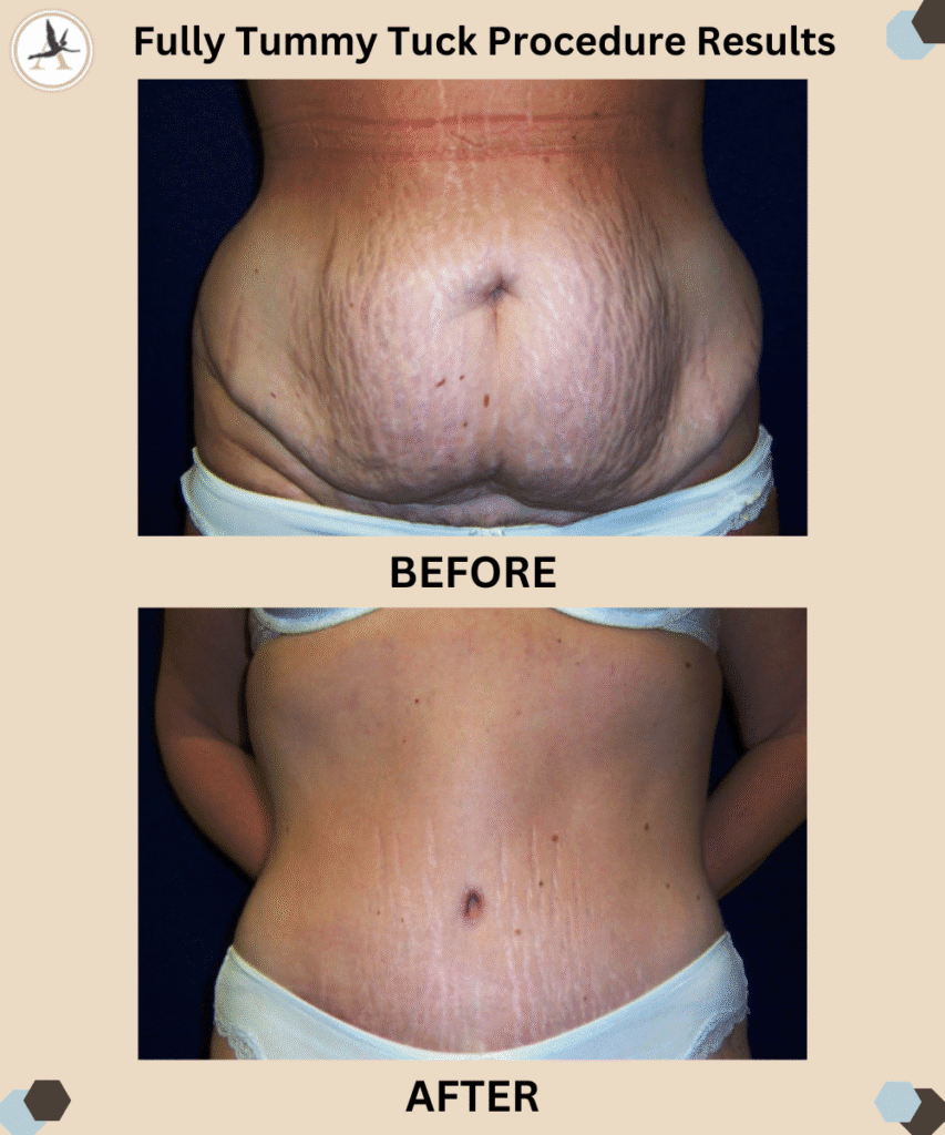 Fully Tummy Tuck Procedure Before and After Results_Does a Tummy Tuck Have Medical Benefits Get Slimmer Waistline in Tampa, Florida