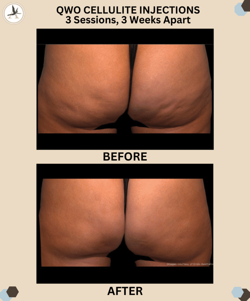 Qwo Cellulite Injections 3 Sessions, 3 Weeks Apart_3 Procedures to Support Your Resolutions - Plastic Surgery Tampa