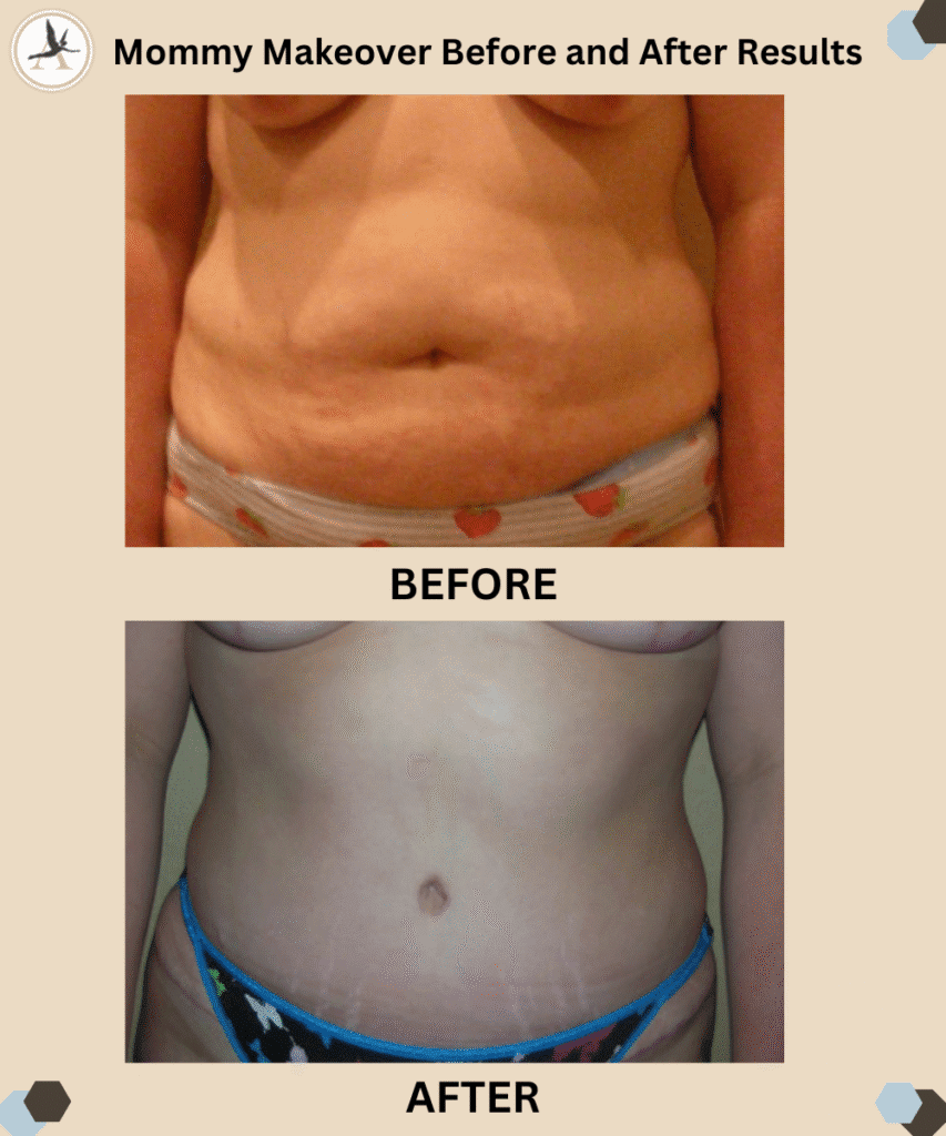 Mommy Makeover Before and After Results_What Can a Mommy Makeover Do For You Benefit, Recovery Tips