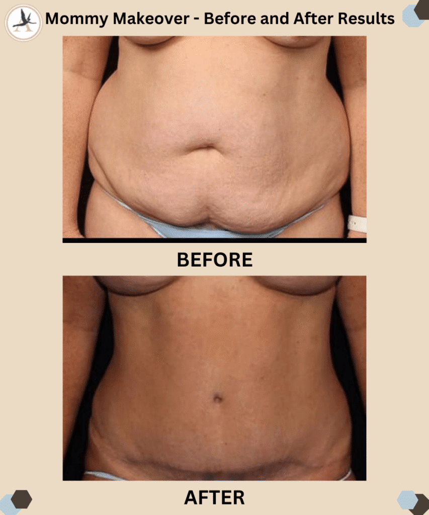 Mommy Makeover _Before and After Results Tampa, Bay, Florida_What Procedures Are Included in a Mommy Makeover
