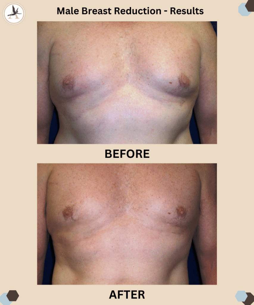 Male Breast Reduction Mammoplasty - Gynecomastia Care Guide in Tampa Bay, Florida