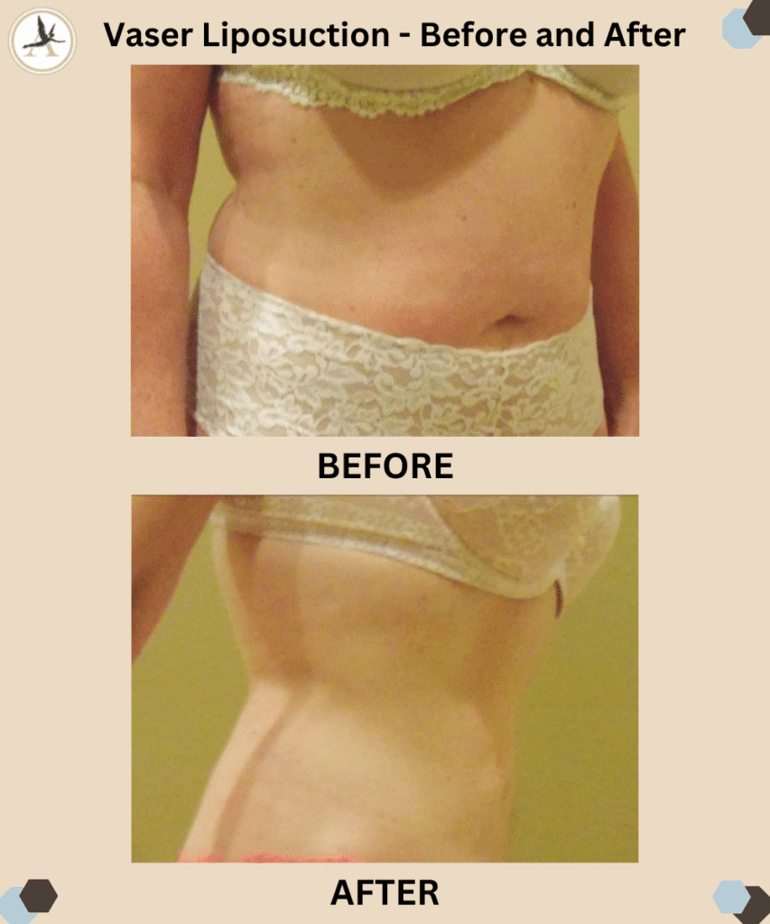 Vaser Liposuction - Before and After Results_Face, Chin, and Neck Fat Removal Procedure