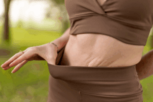 Ozempic Loose Skin Solutions Arms, Belly, Neck Options in Tampa