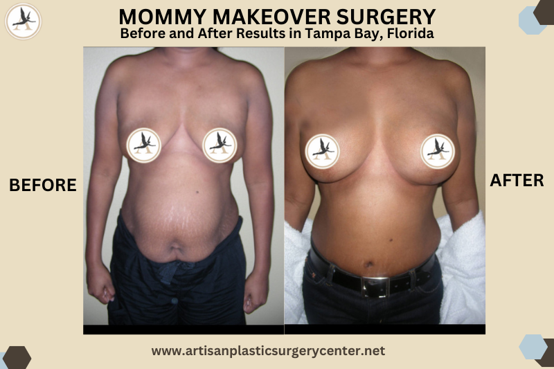 Mommy Makeover Surgerya Before and After Results in Tampa, Florida_New Year Mommy Makeover - Tampa Expert Care, Lasting Results
