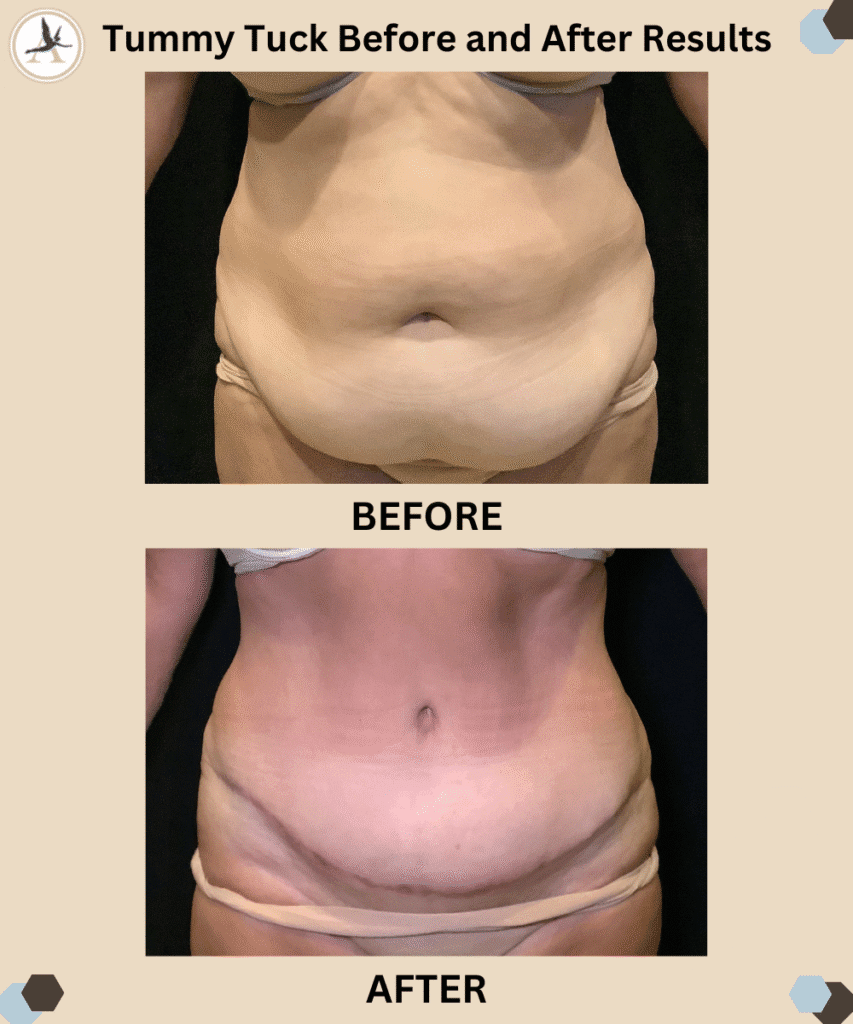 Tummy Tuck Before and After Results_Restore Figure with Tummy Tuck - Rediscover Your Pre-Baby Body in Tampa Bay, Florida