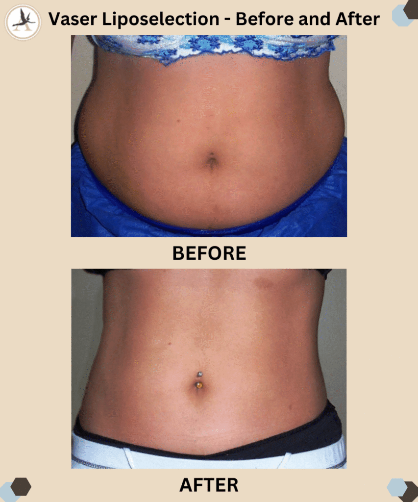 Vaser Liposelection Procedure _Before and After Results_- Modern Body Contouring in Tampa Bay, Florida