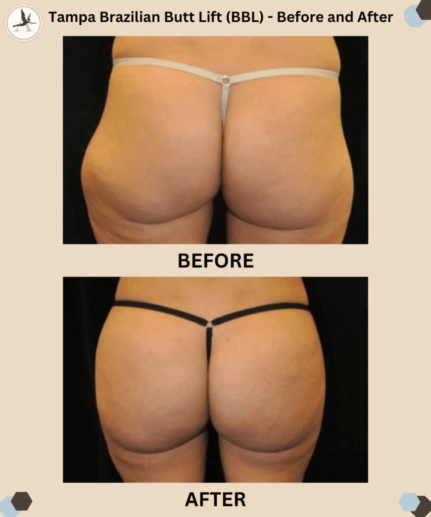 Brazilian Butt Lift Booty Enhancement_Transform Your Curves_ Before and After Results Tampa Bay, Florida