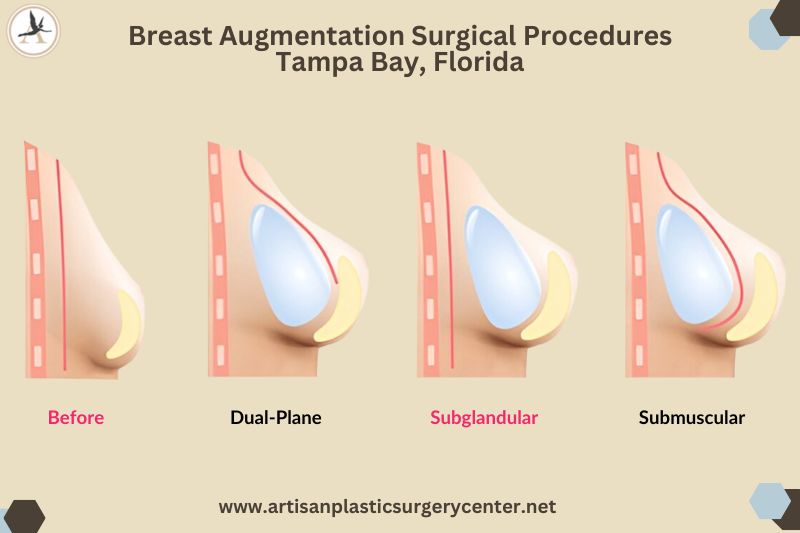 Breast Augmentation Surgical Procedures Tampa Bay, Florida