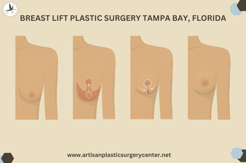 Breast Lift Plastic Surgery Tampa Bay, Florida