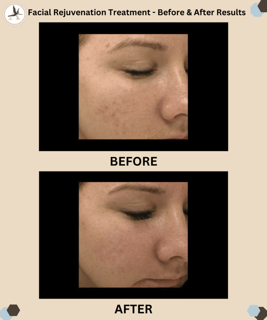 Facial Rejuvenation Treatments Near Me - Before and After Results in Tampa Florida
