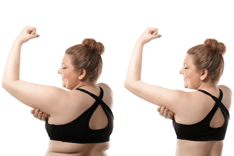 Go Sleeveless Arm Lift - Refine Arm Contour with Brachioplasty in Tampa Bay, Florida