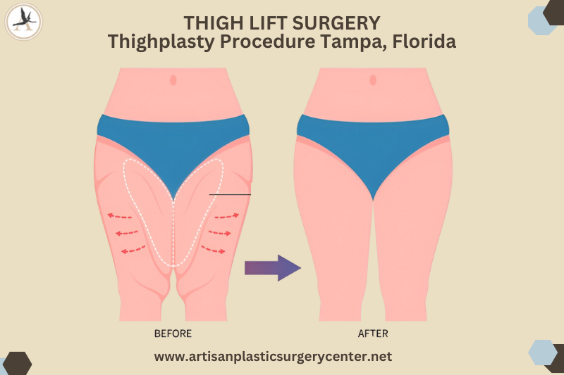 THIGH LIFT SURGERY_Thighplasty Procedure Tampa Bay, Florida