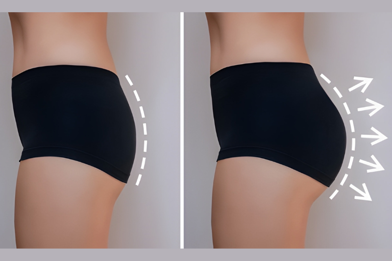 Brazilian Butt Lift BBL Fat Transfer_Before and After Results in Tampa Bay, Florida FL