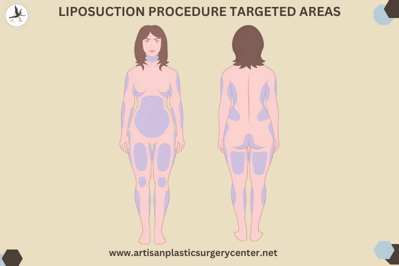 Liposuction Procedure Targeted Areas in Tampa BAy, Florida