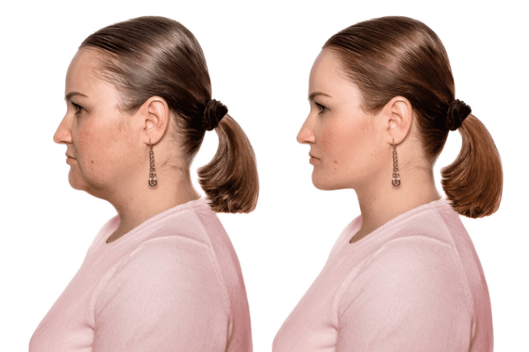 Kybella Minimally Invasive Injectable - Double Chin Treatment in Tampa Bay, FL
