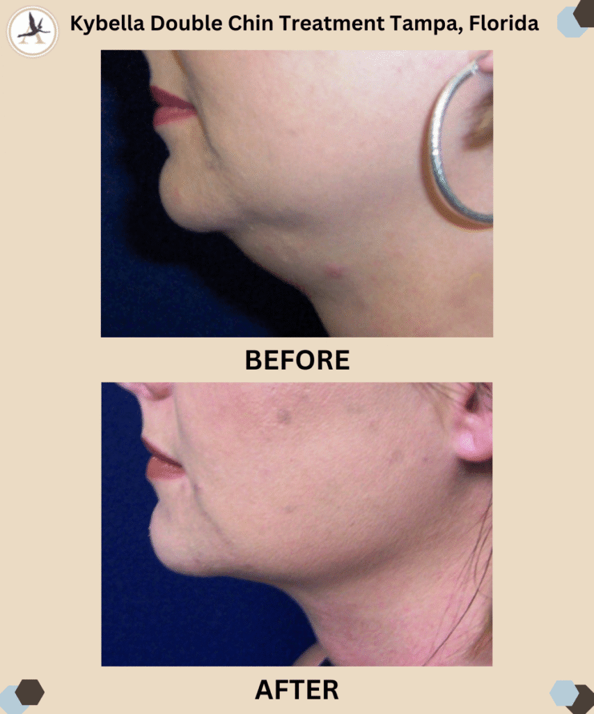 Kybella Minimally Invasive Injectable - Double Chin Treatment in Tampa Bay, Florida