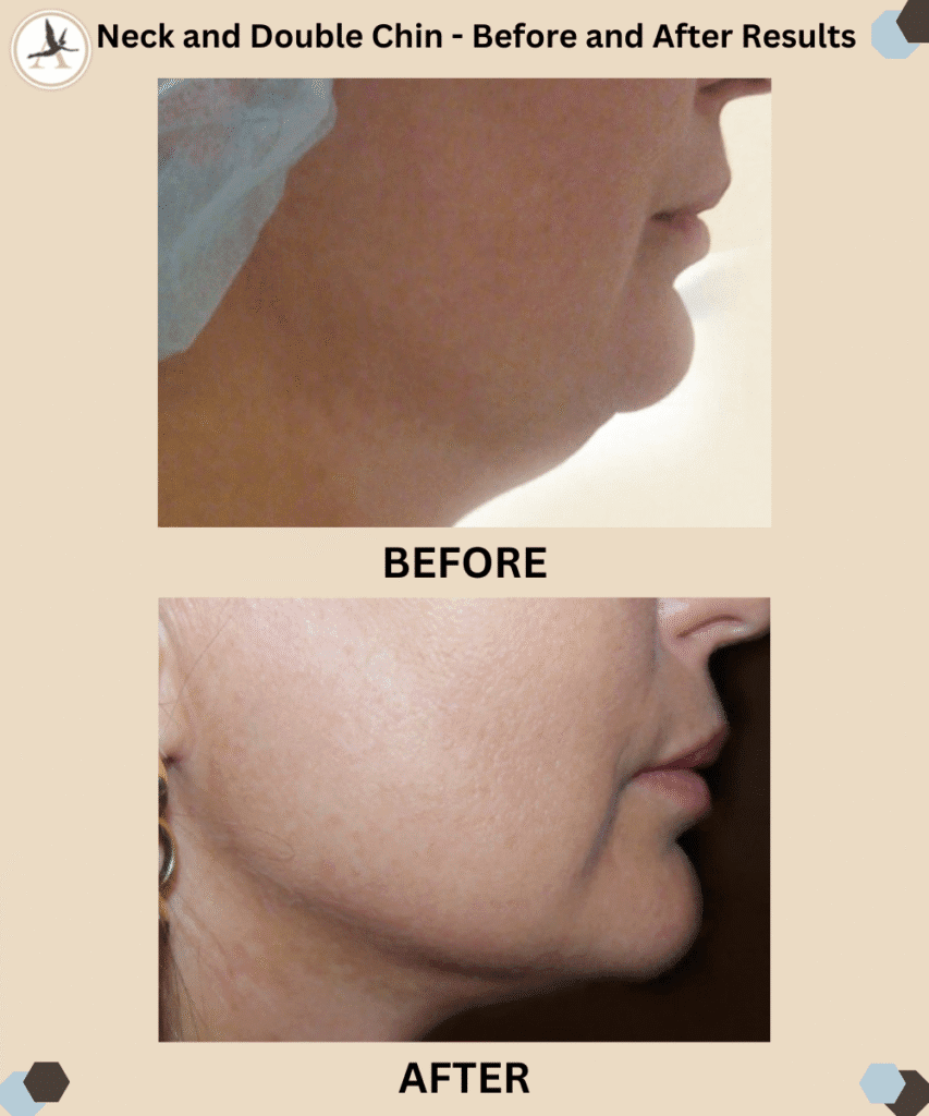 VASER Liposuction of Neck and Double Chin_Get Rid of Turkey Neck in Tampa Bay, Florida