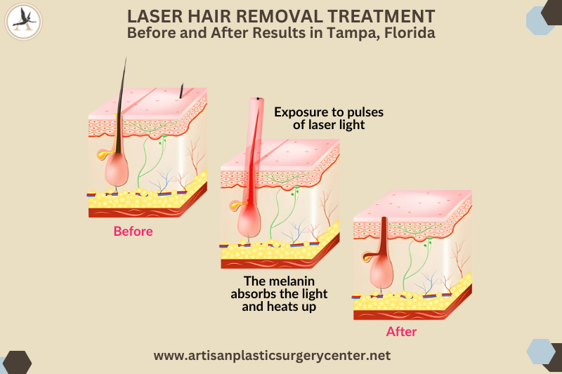 Laser hair Removal Treatment Before and After Results in Tampa, Florida
