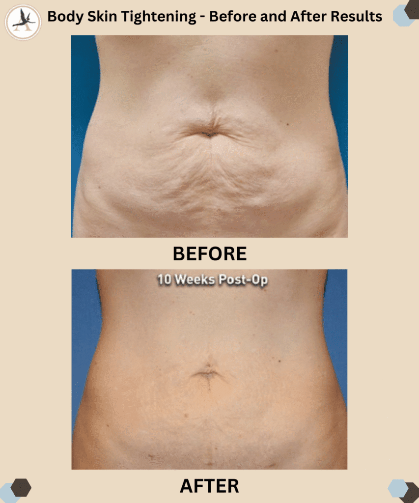 Body Skin Tightening - Before and After Results in Tampa, Florida_Best Treatment for Skin Tightening - Renuvion vs. Lasers and Peels