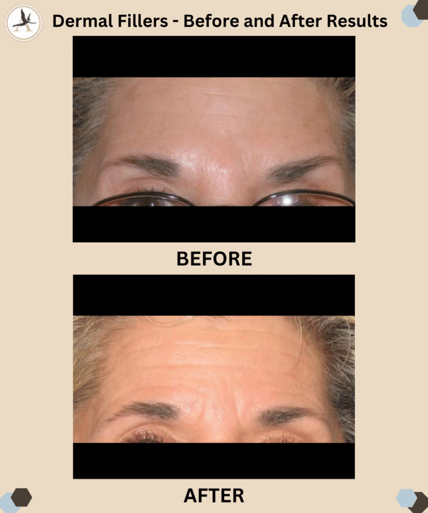 Dermal Fillers _Before and After Results Tampa, Florida_Which Filler Lasts the Longest Facial Cosmetic Enhancement FL