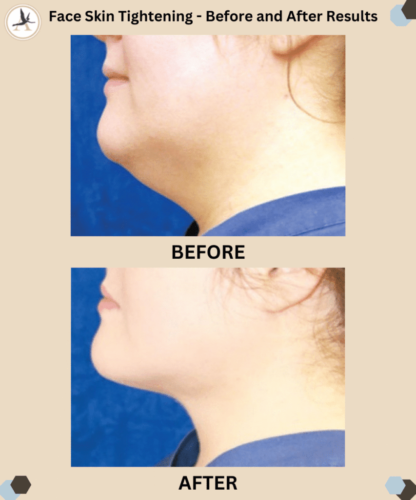 Face Skin Tightening - Before and After Results in Tampa, Florida_Best Treatment for Skin Tightening - Renuvion vs. Lasers and Peels