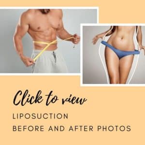 before & after SmartLipo® Tampa FL