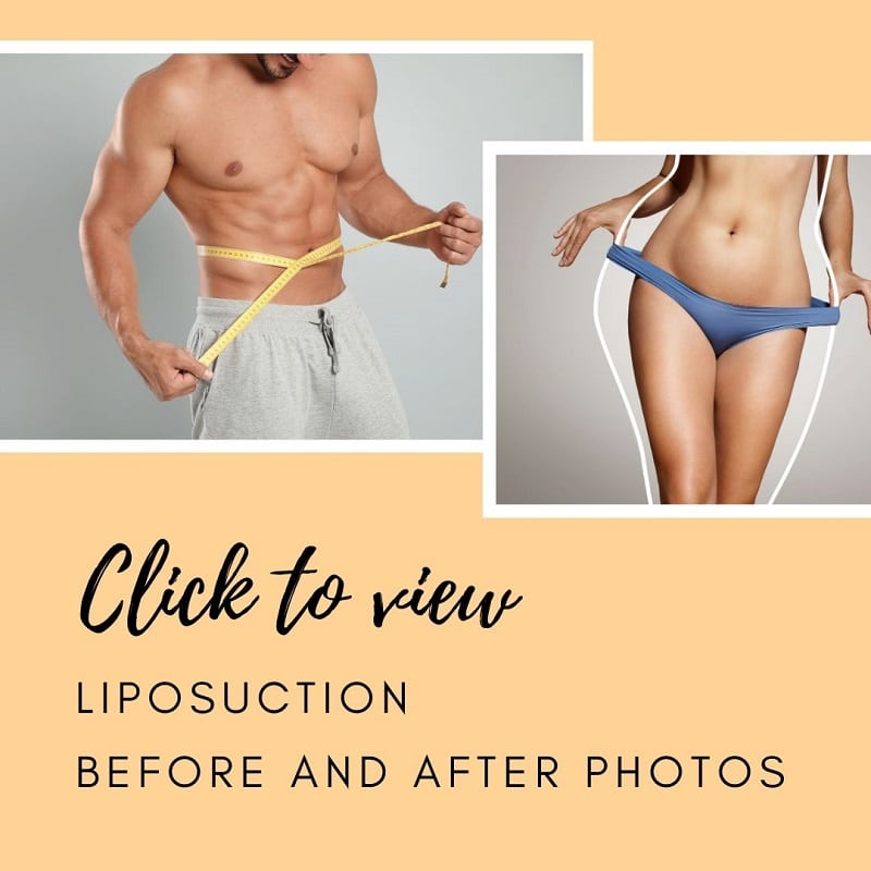 Vaser® Liposuction Tampa FL