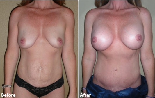 mommy makeover