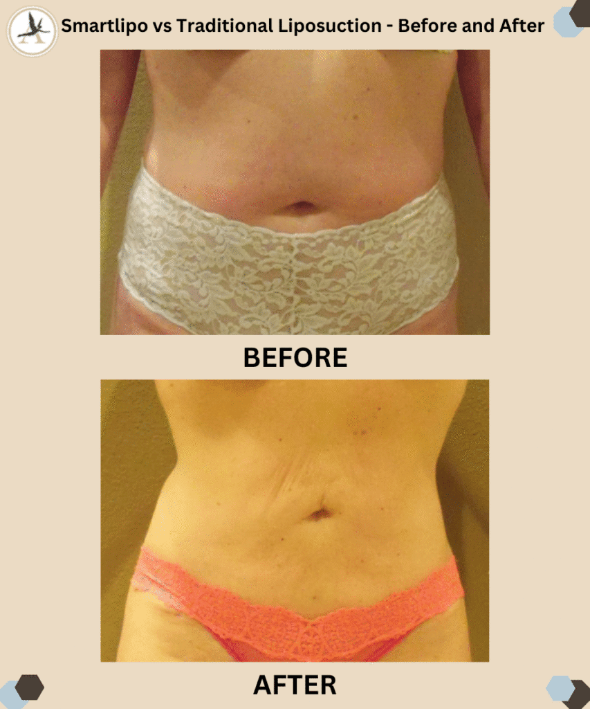 Smartlipo vs Traditional Liposuction_Before and After Results_ Key Differences and Recovery in Tampa, Florida