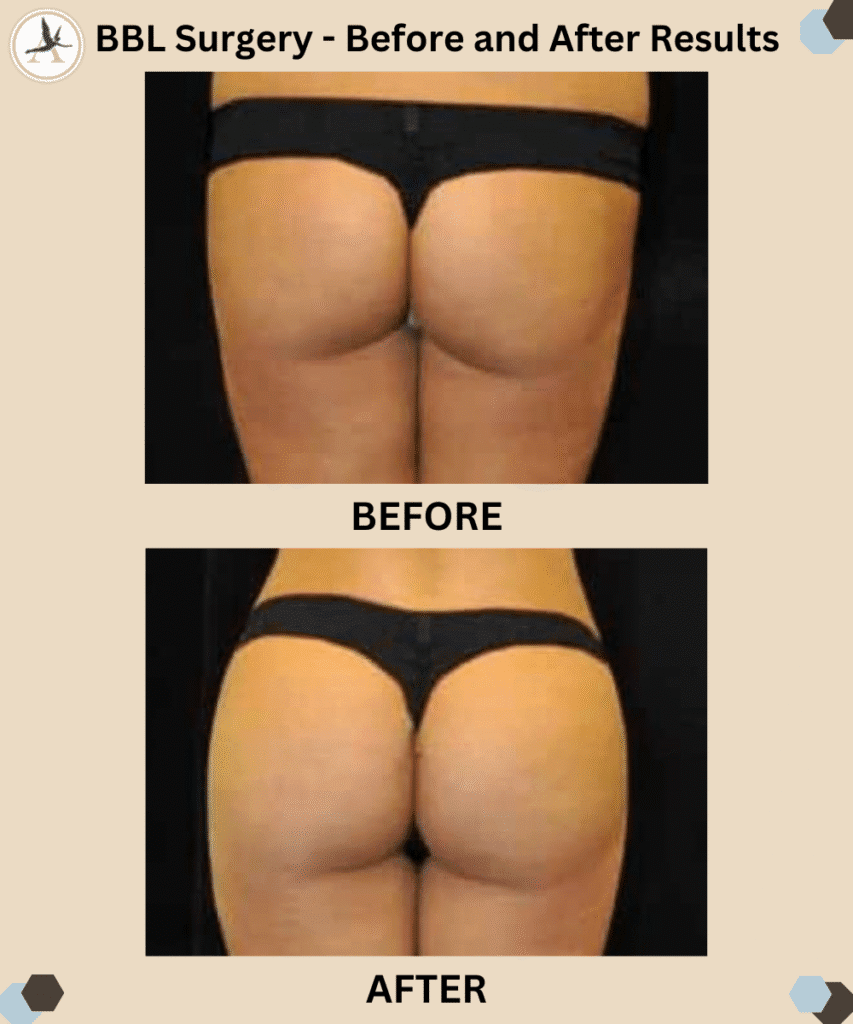 BBL Surgery Before and After Results Tampa Florida_Tips for Brazilian Butt Lift - Advanced Buttocks Enhancement
