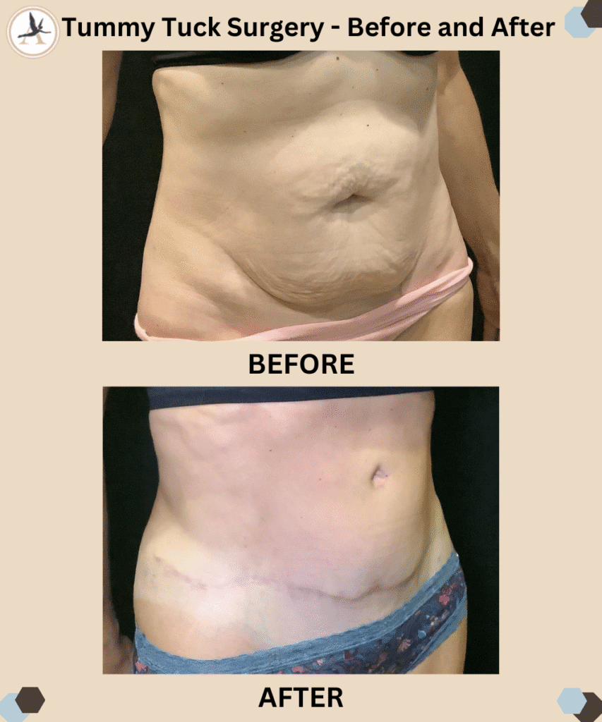 Tummy Tuck Surgery - Before and After Tampa Florida_Alternatives to a Tummy Tuck - Non‑Surgical Options Guide