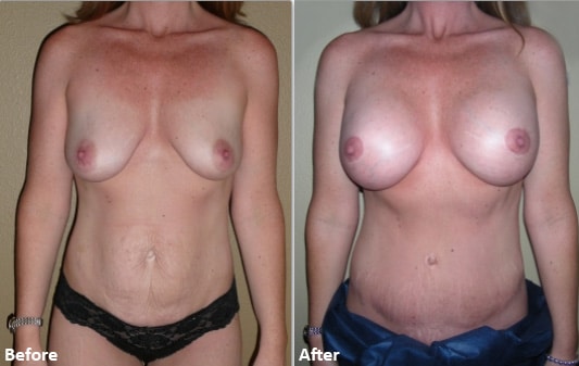 topless woman before and after mommy makeover, stomach flatter and breasts enlarged after procedure