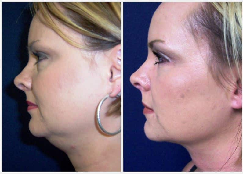 En consecuencia Fiel Todo tipo de 4 Things to Know About Chin Liposuction | Tampa Bay, FL
