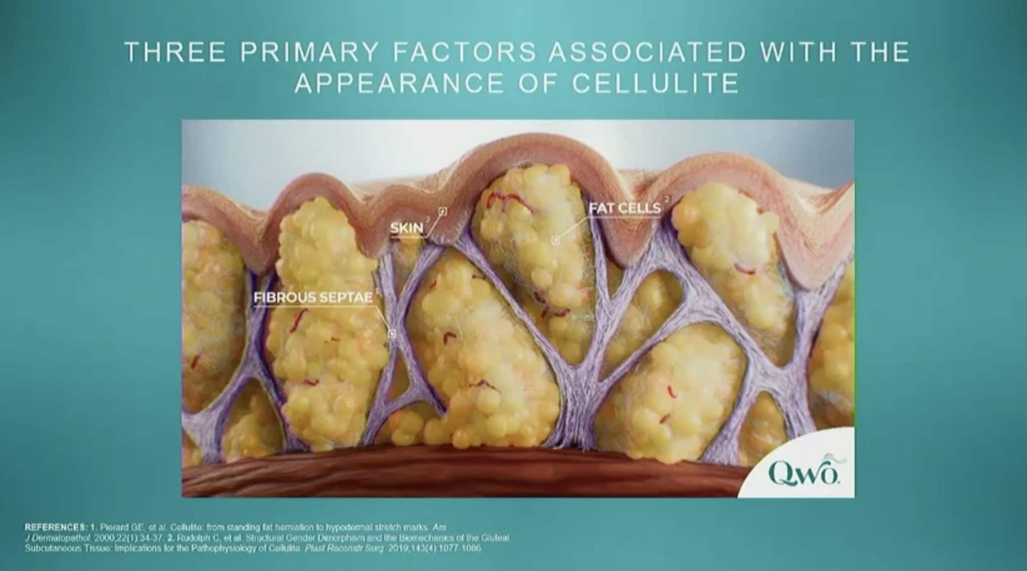 Qwo Cellulite Injections Artisan Aesthetics Plastic Surgery & Laser
