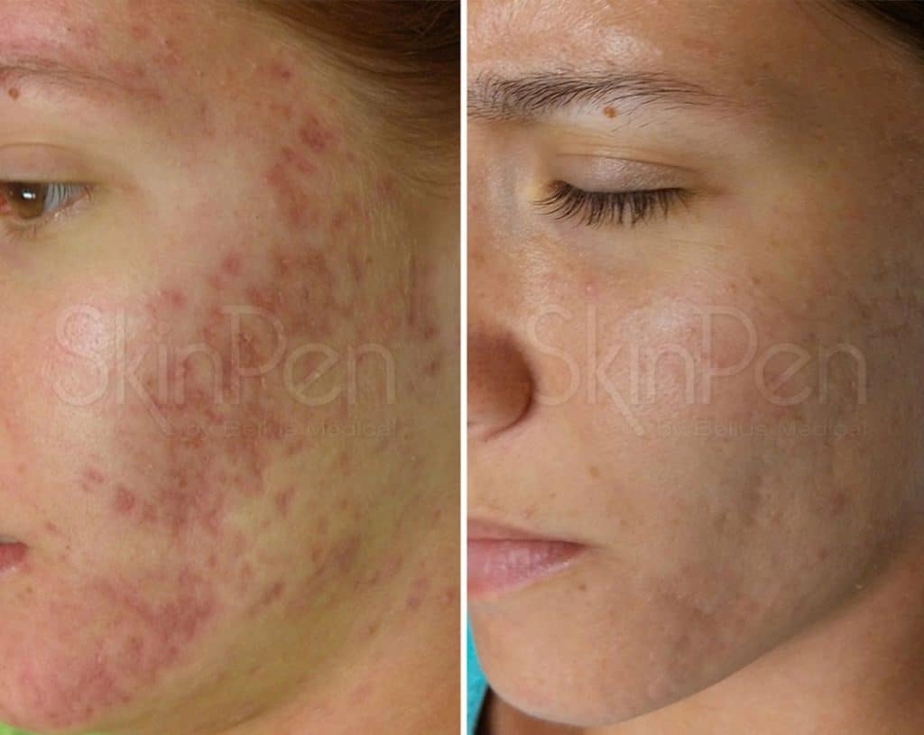 Before & after Image of Skin Pen® Microneedling Tampa