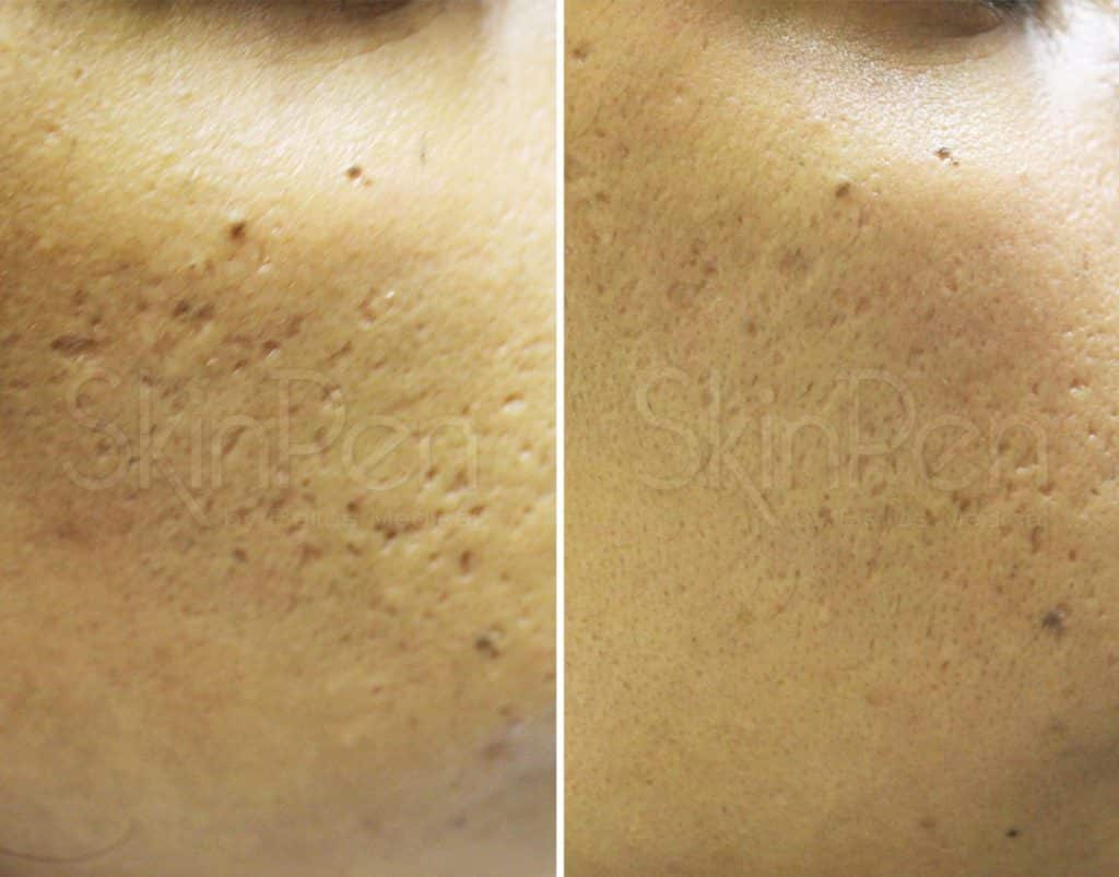 Before & after Image of Microneedling Tampa FL