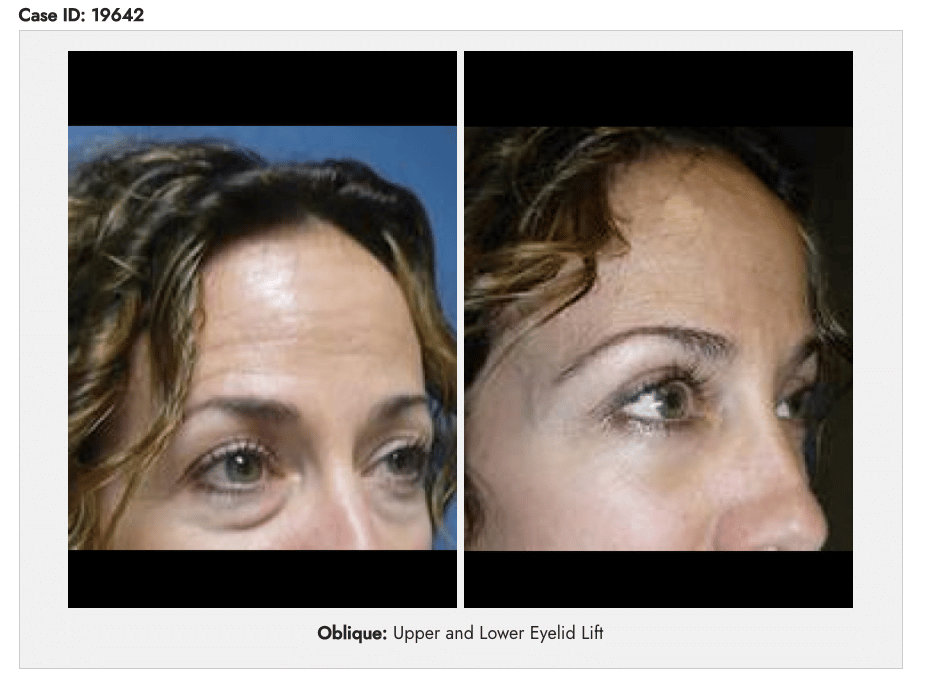 upper and lower eyelid lift before and after