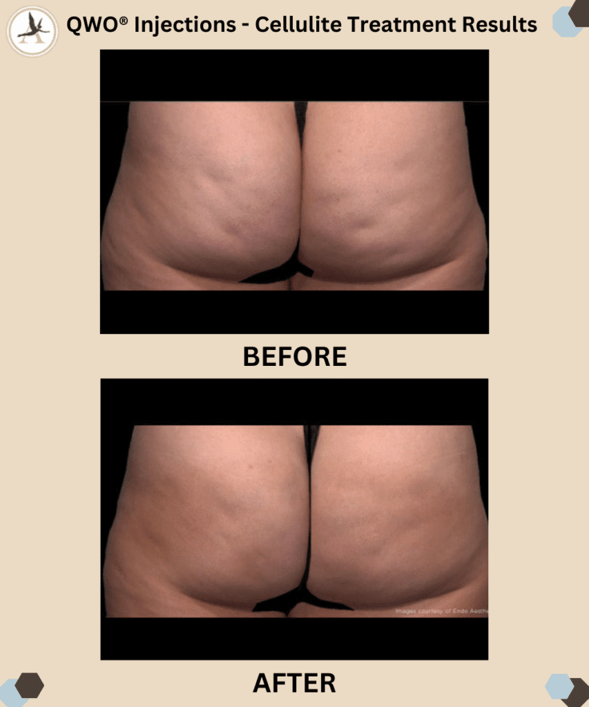 QWO® Injections - Cellulite Treatment Before and After Results_Pros and Cons of QWO - Minimally Invasive Cellulite Treatment in Tampa Florida