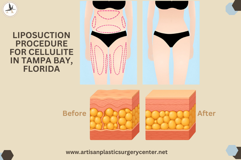 Liposuction Procedure for Cellulite in Tampa bay, Florida (1)