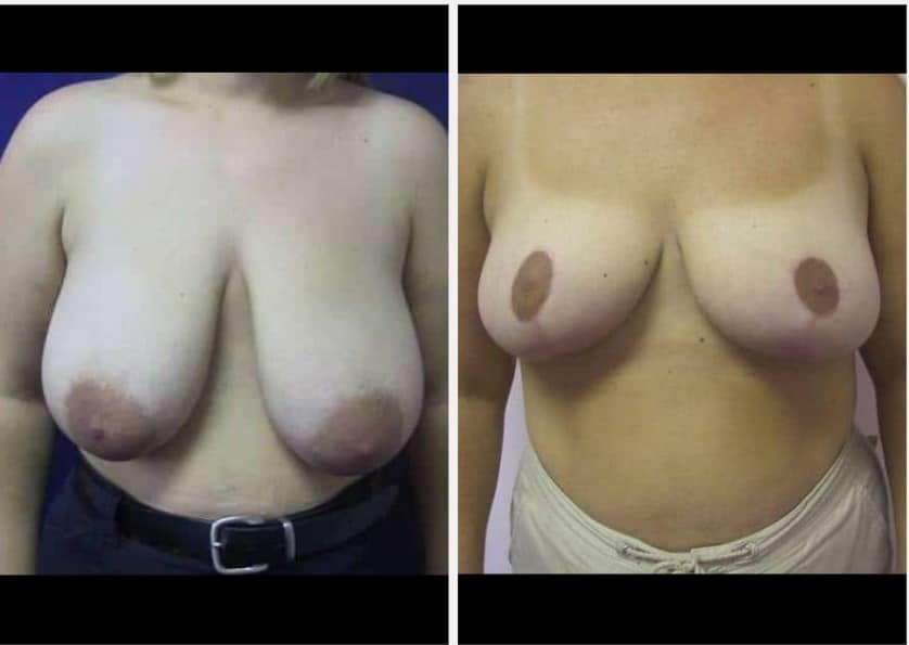 topless woman before and after breast reduction