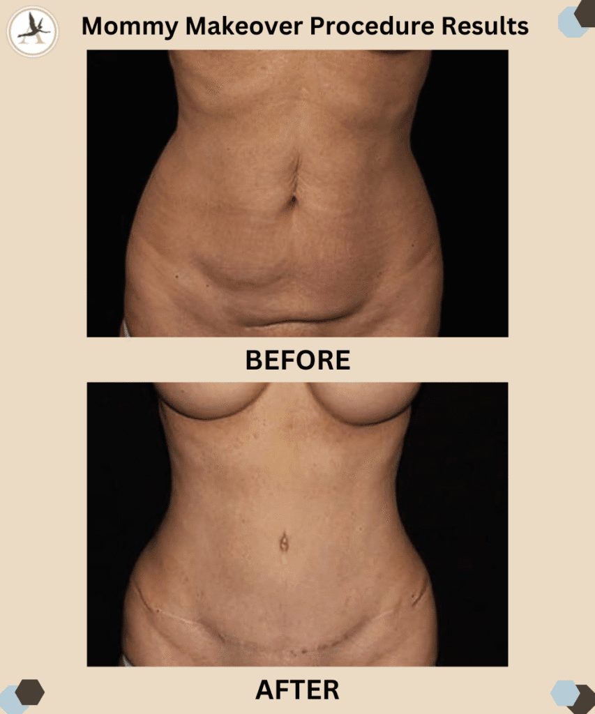 Mommy Makeover _Before and After Results Tampa, Bay, Florida_Questions to Ask Before Mommy Makeover Key Considerations